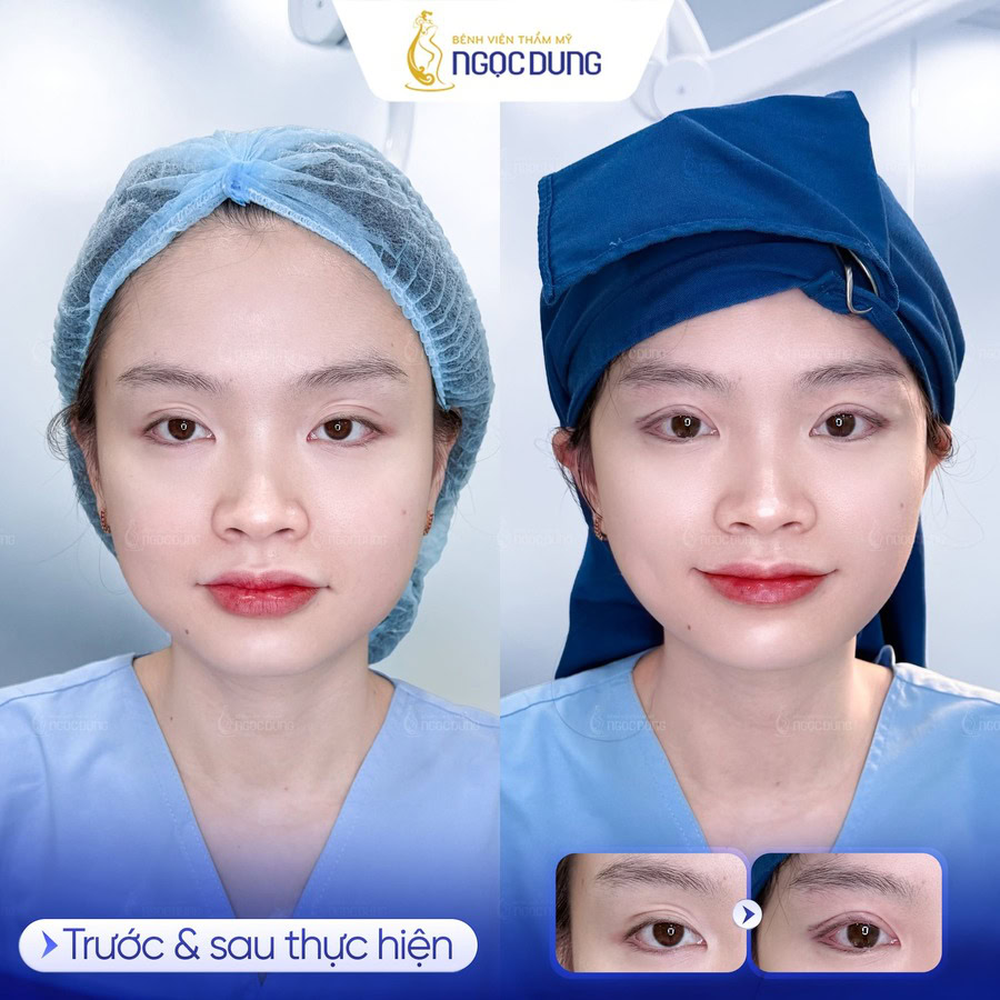 Cách nhấn mí tạo mắt 2 mí tại nhà không cần phẫu thuật 12 Khách hàng sau khi thực hiện tại Bệnh viện thẩm mỹ Ngọc Dung