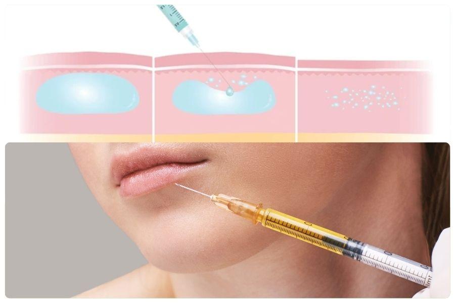 Giải đáp về tiêm tan filler: Phân loại, các dấu hiệu và lưu ý 10 Khi filler không đạt kết quả như mong muốn, tiêm tan giúp “reset” gương mặt an toàn và có kiểm soát