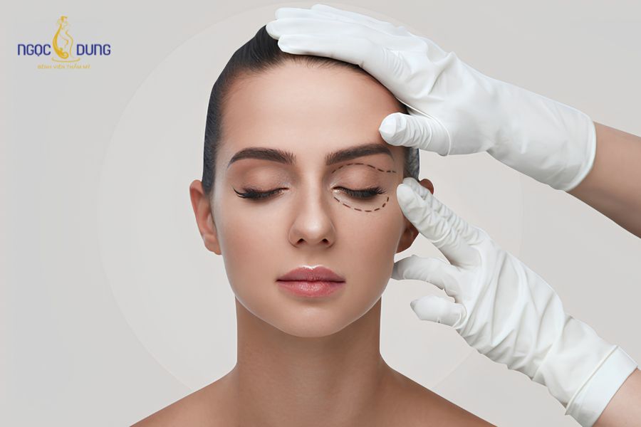 Mỡ mí mắt trên là tình trạng tích tụ các mô mỡ dày dưới da do lão hóa hoặc di truyền