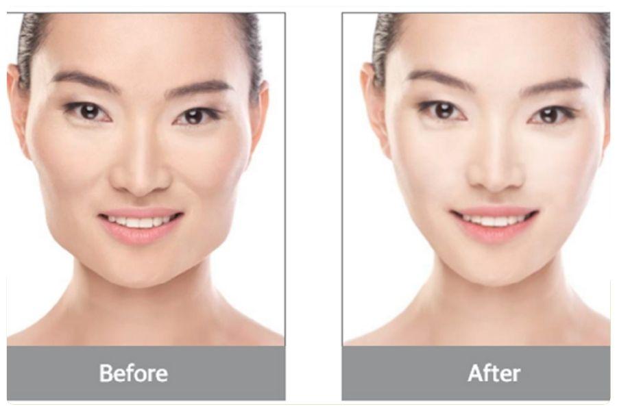 Tiêm botox gọn hàm bao nhiêu cc? Những yếu tố ảnh hưởng 13 Mỗi gương mặt cần một phác đồ botox được cá nhân hóa riêng biệt