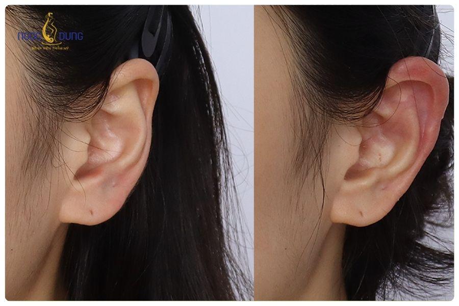Tiêm filler tai tài lộc có an toàn không? Những điều bạn cần biết 19 Một số trường hợp có thể xuất hiện tình trạng sưng nhẹ trong vài ngày đầu sau khi tiêm filler tai