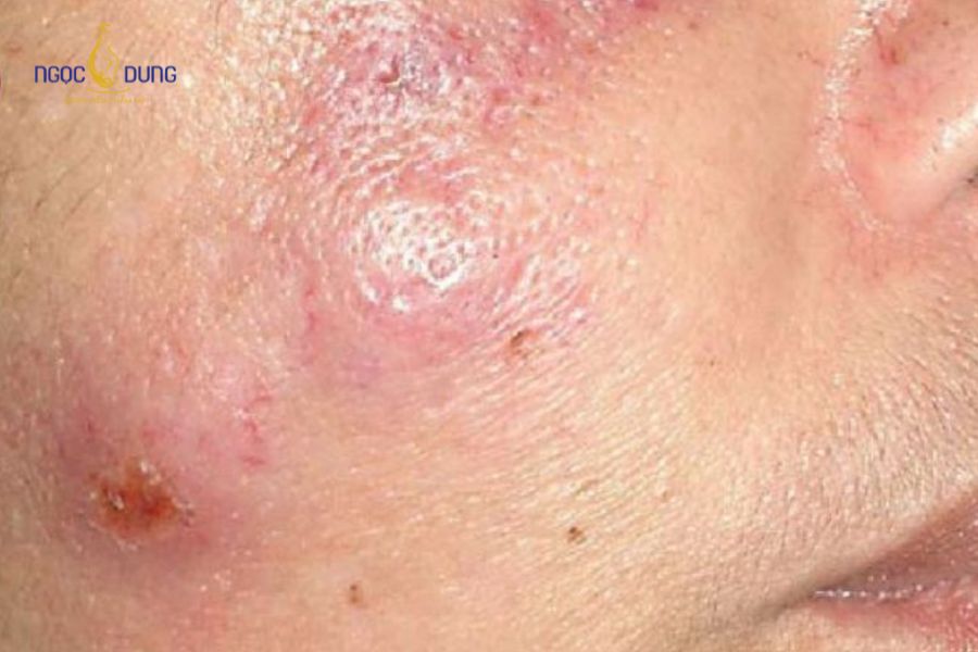 6 Tác hại của tiêm meso: Cần lưu ý trước khi thực hiện 13 Nếu sưng bầm da nghiêm trọng sau meso cần đi thăm khám bác sĩ