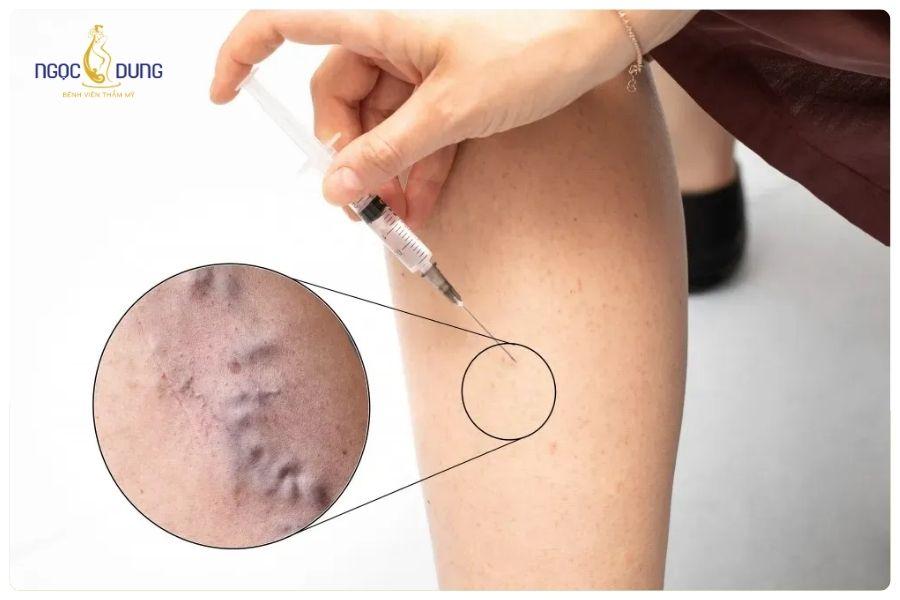 Lợi ích của tiêm botox thon gọn bắp chân? Lưu ý khi tiêm? 15 Nếu tiêm sai khi thuật có thể ảnh hưởng đến các cơ xung quanh