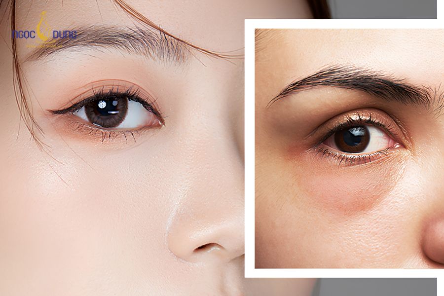 Cách làm giảm bọng mắt và quầng thâm hiệu quả, nhanh chóng 7 Nguyên nhân dẫn đến tình trạng bọng mắt, quầng thâm có thể từ nhiều yếu tố