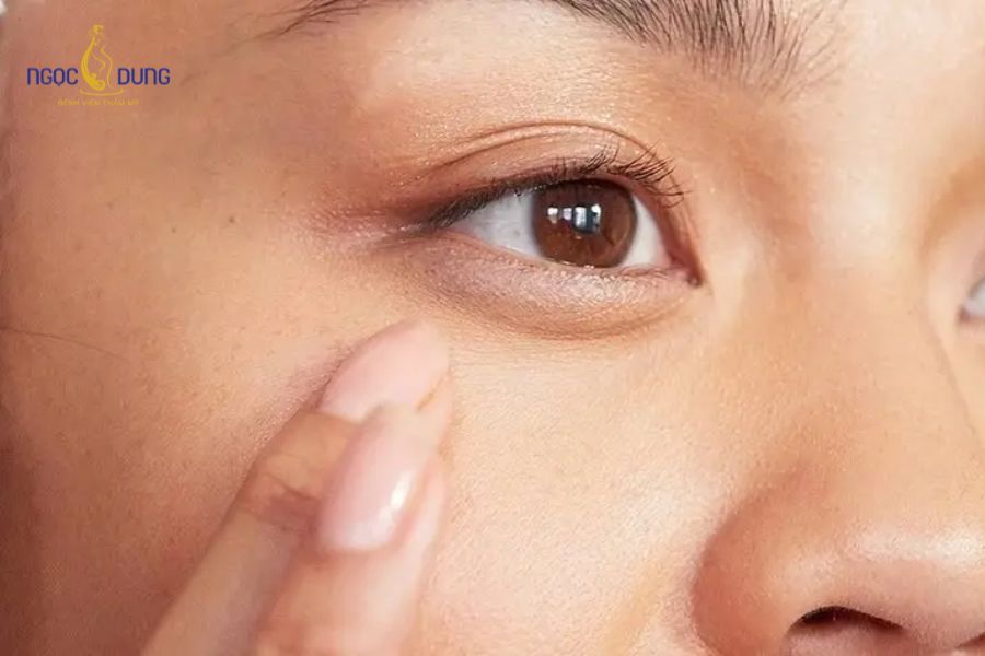 Bọng mắt là gì? Nguyên nhân và cách phòng ngừa bọng mắt hiệu quả 6 Nguyên nhân gây bọng mỡ dưới mắt là gì phụ thuộc vào nhiều yếu tố
