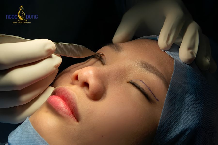 Nhấn mí bằng chỉ là gì? Có nên nhấn mí bằng chỉ không? 8 Nhấn mí bằng chỉ chỉ định tối ưu cho người trẻ tuổi có nền da mắt săn chắc, ít khuyết điểm mỡ thừa