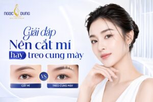 Nhấn mí hay cắt mí