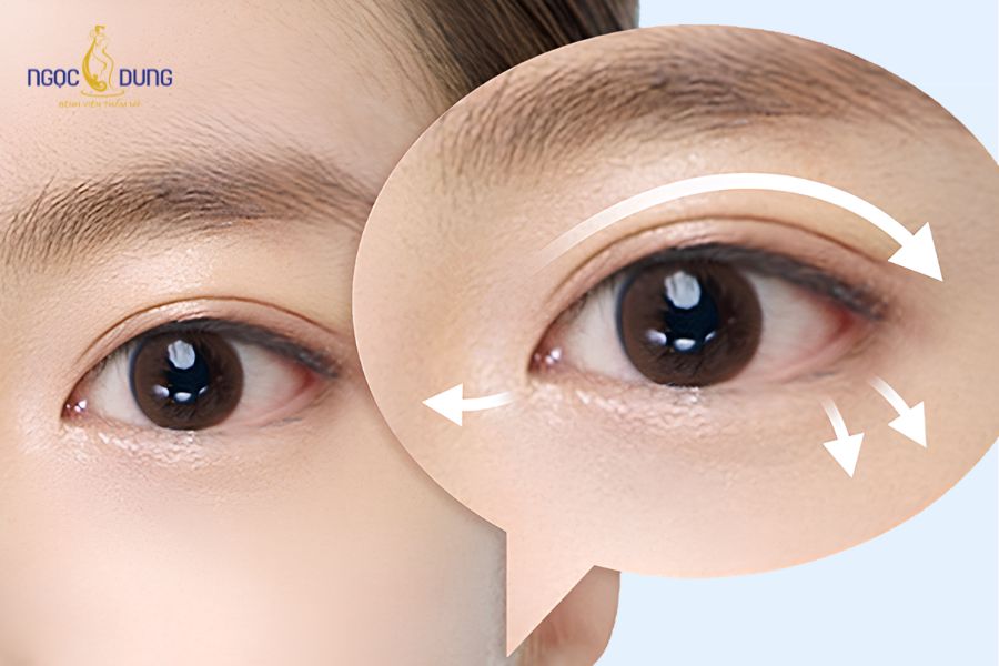 Có nên nhấn mí mắt không? Mắt sụp nên nhấn mí hay cắt mí? 8 Nhấn mí mắt là lựa chọn tối ưu cho người trẻ tuổi sở hữu nền da mắt săn chắc, chưa bị lão hóa