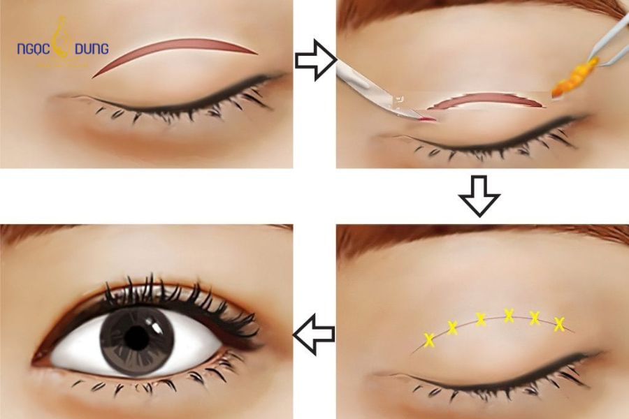 Có nên nhấn mí mắt không? Mắt sụp nên nhấn mí hay cắt mí? 6 Nhấn mí mắt là thủ thuật xâm lấn tối thiểu giúp tạo nếp mí tự nhiên mà không cần phẫu thuật bóc tách