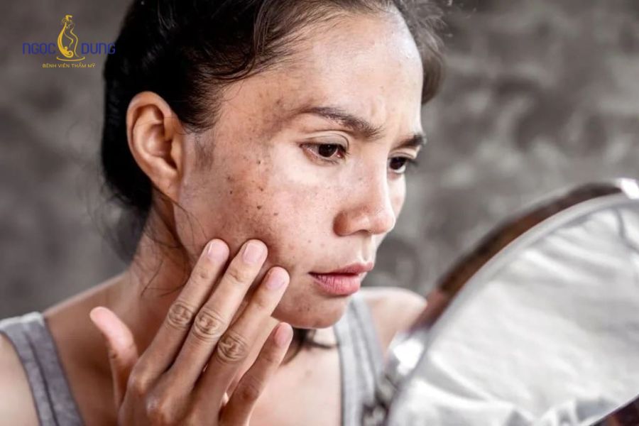 Tiêm meso trị nám có hiệu quả không? Cơ chế hoạt động và lưu ý 15 Nhiều người mong muốn cải thiện nám sau liệu trình meso