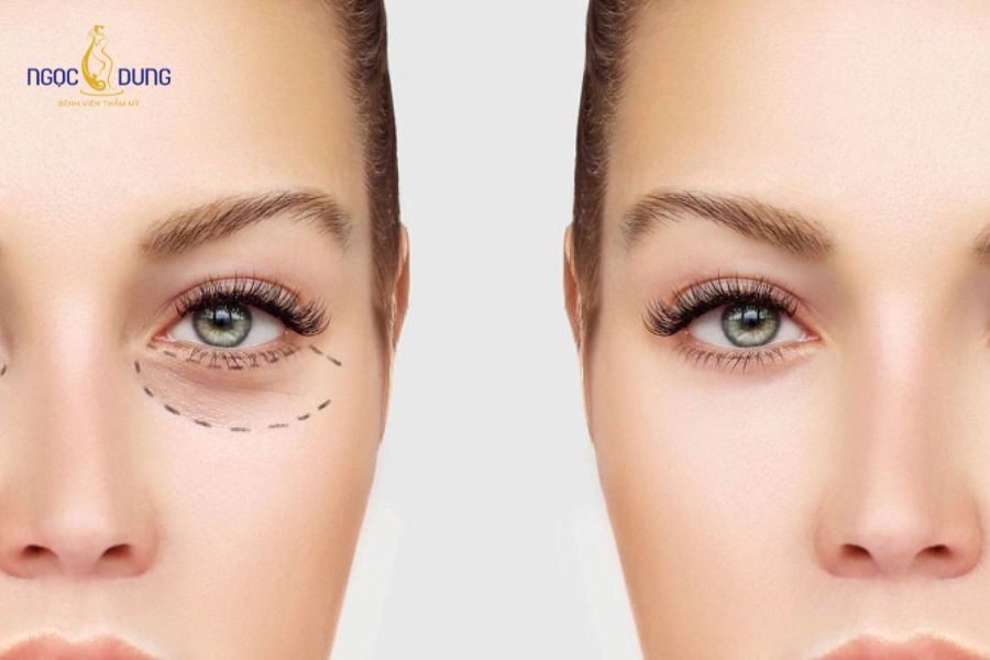 Phẫu thuật cắt bọng mắt dưới: Thông tin cần biết từ A–Z 6 Phẫu thuật cắt bọng mắt dưới giúp khắc phục tình trạng da chùng, mỡ thừa mi dưới do lão hóa