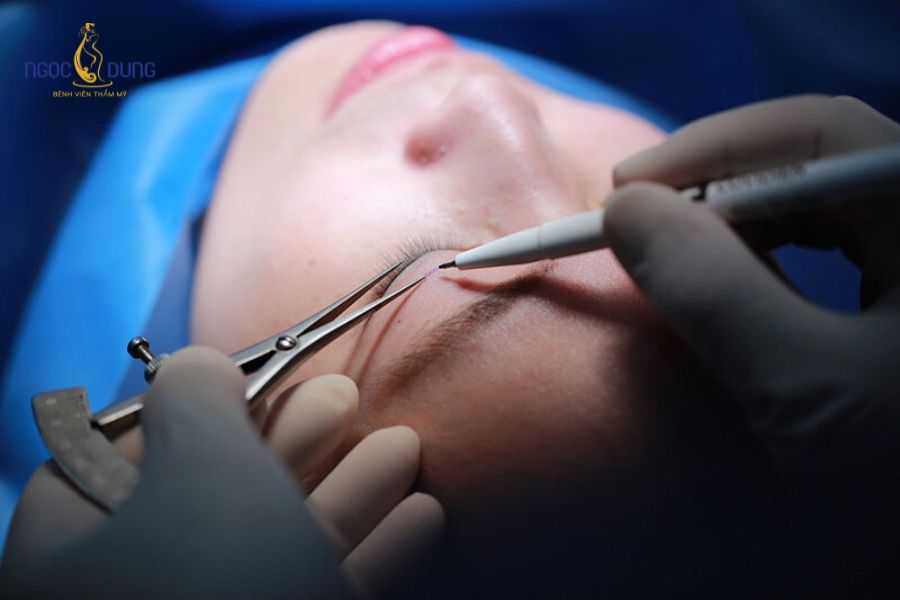 Treo cung chân mày là gì? Vì sao nên thực hiện treo chân mày 9 Phương pháp phẫu thuật treo chân mày giúp giải quyết triệt để tình trạng da chùng, mỡ thừa cho hiệu quả lâu dài