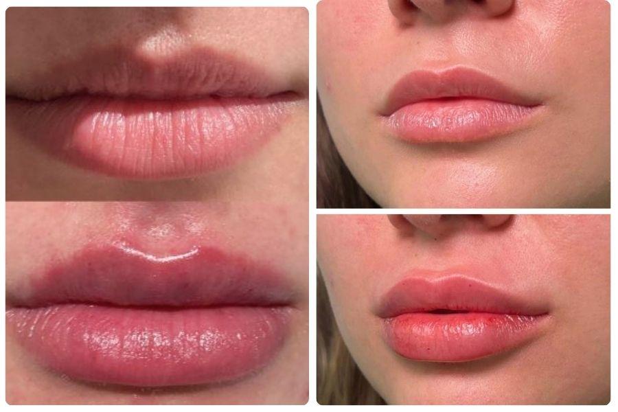 Tiêm filler môi bao lâu thì mềm? Bí quyết giúp môi vào form nhanh 9 Sau tiêm, môi cần thời gian để thích nghi và mềm mại tự nhiên hơn từng ngày