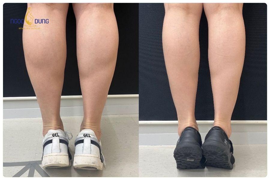 Lợi ích của tiêm botox thon gọn bắp chân? Lưu ý khi tiêm? 16 Tiêm botox bắp chân giúp dáng chân thon gọn và cân đối hơn