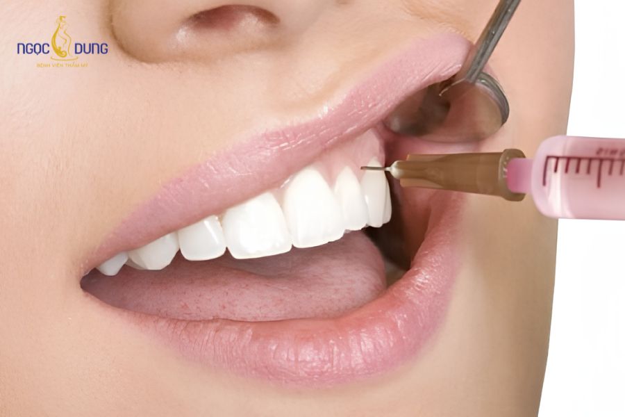 Tiêm Botox Cười Hở Lợi: Giải Pháp Nhanh, Không Phẫu Thuật 11 Tiêm botox cười hở lợi là giải pháp mang lại kết quả nhanh chóng, không cần phẫu thuật