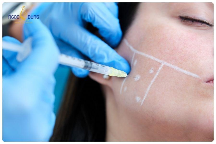 Phân biệt filler và botox khác gì nhau ? Cái nào tốt hơn 8 Tiêm botox giúp gương mặt thon gọn tự nhiên hơn