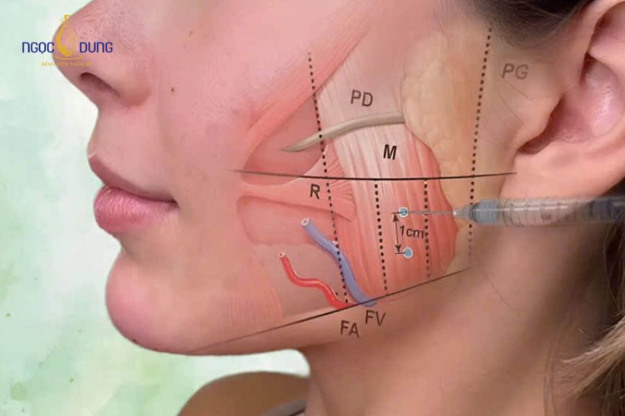 Tiêm botox gọn hàm được yêu thích hiện nay