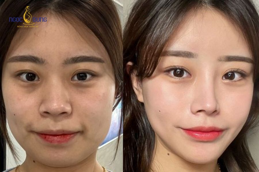 Tác hại của tiêm botox gọn hàm và những lưu ý cần biết 14 Tiêm Botox gọn hàm giúp gương mặt thanh thoát hơn