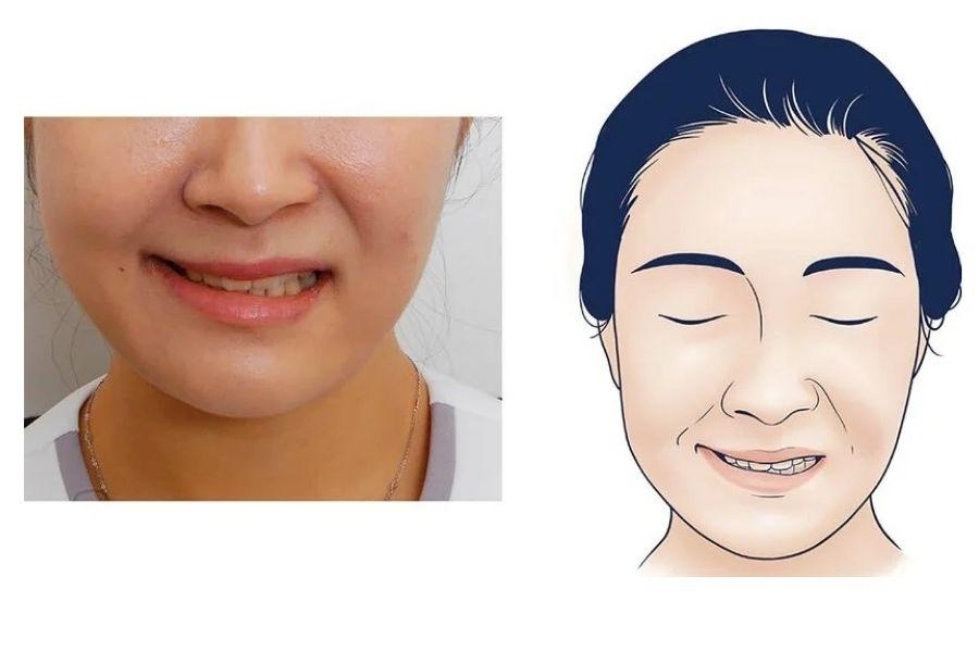 Tiêm botox gọn hàm bao nhiêu cc? Những yếu tố ảnh hưởng 17 Tiêm botox quá liều có thể gây mất cân đối gương mặt