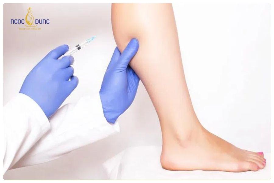 Lợi ích của tiêm botox thon gọn bắp chân? Lưu ý khi tiêm? 13 Tiêm botox thon gọn bắp chân giúp chân thon gọn tự nhiên, không cần phẫu thuật