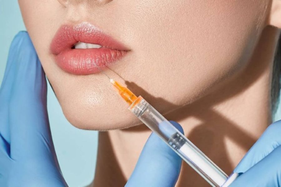 TOP 10+ dáng môi tiêm filler đẹp tự nhiên và HOT TREND hiện nay 13 Tiêm dáng môi cong tự nhiên có đường cong môi nhẹ nhàng