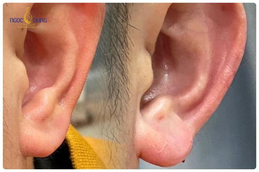 Tiêm filler tai tài lộc có an toàn không? Những điều bạn cần biết 18 Tiêm filler tai giúp cải thiện dáng tai đầy đặn mà không để lại sẹo