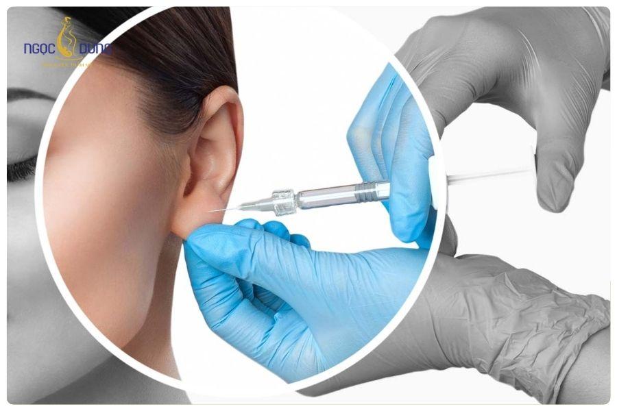 Tiêm filler tai là xu hướng làm đẹp giúp cải thiện dáng tai đầy đặn và hài hòa hơn