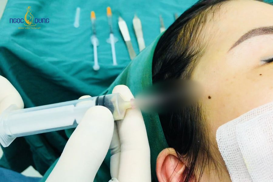 Tiêm filler thái dương là gì? Có nguy hiểm không? 17 Tiêm filler thái dương có thể gặp biến chứng nếu chọn cơ sở không uy tín