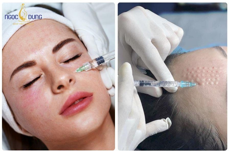 Nên tiêm Meso bao lâu 1 lần là tốt nhất? Những yếu tố ảnh hưởng 15 Tiêm meso đúng liệu trình giúp đảm bảo an toàn và hạn chế biến chứng