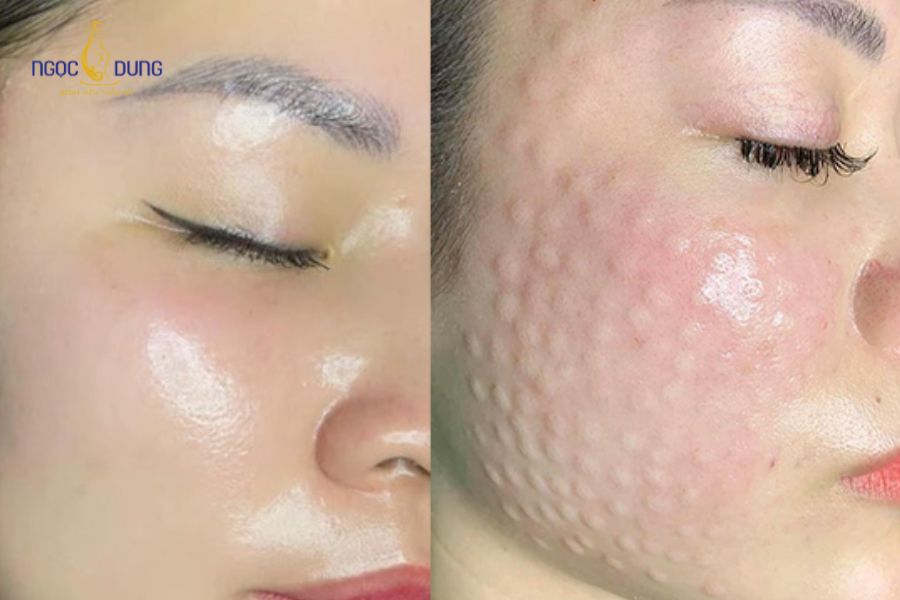 Tiêm meso trị nám có hiệu quả không? Cơ chế hoạt động và lưu ý 16 Tiêm meso giúp da nhanh phục hồi