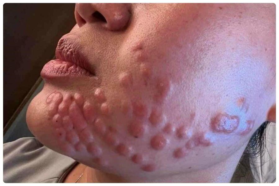Tiêm meso là gì? Những công dụng chính của tiêm meso 17 Tiêm meso không đúng kỹ thuật có thể làm tăng nguy cơ hình thành u hạt dưới da