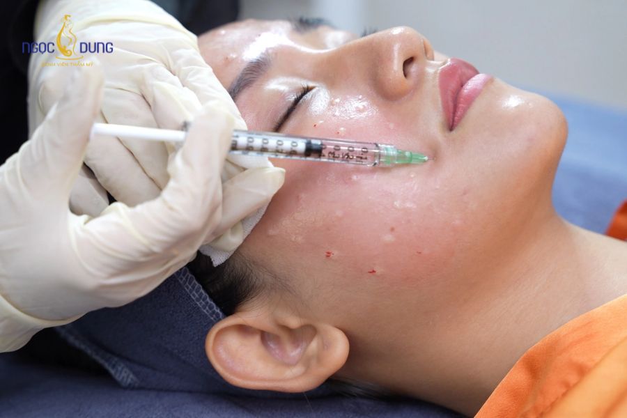 Sau khi tiêm meso cần kiêng gì? Những lưu ý quan trọng 9 Tiêm meso không nguy hiểm khi thực hiện đúng kỹ thuật