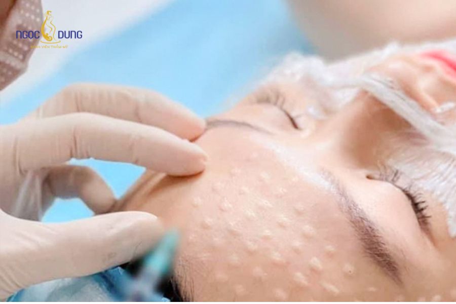 Tiêm meso là phương pháp làm đẹp phổ biến hiện nay