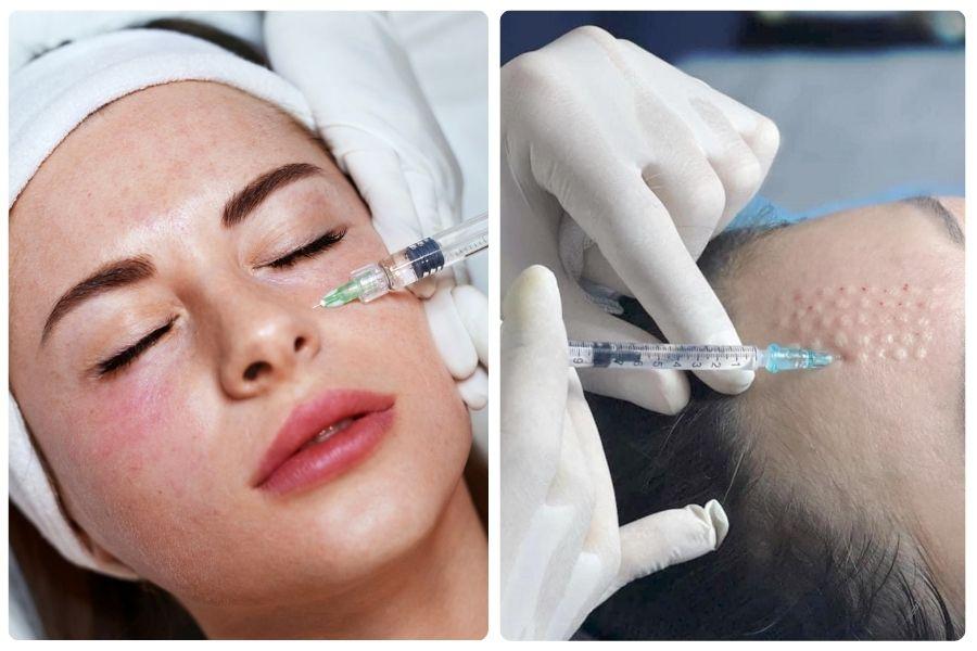 Tiêm meso là gì? Những công dụng chính của tiêm meso 16 Tiêm meso sử dụng kim chuyên dụng để đưa dưỡng chất vào da