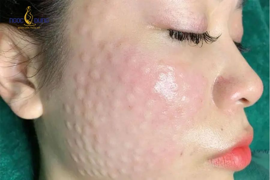 6 Tác hại của tiêm meso: Cần lưu ý trước khi thực hiện 12 Tiêm meso thường không ảnh hưởng sức khỏe nếu chọn cơ sở uy tín