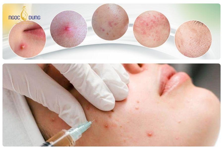 Tiêm meso trị mụn – Giải pháp cải thiện mụn và phục hồi làn da từ sâu bên trong