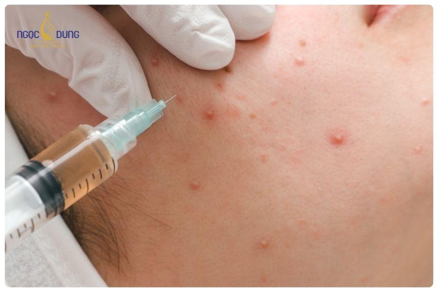 Tiêm meso trị mụn là gì? Những lưu ý khi thực hiện 11 Tiêm meso trị mụn giúp đưa hoạt chất vào sâu lớp trung bì da