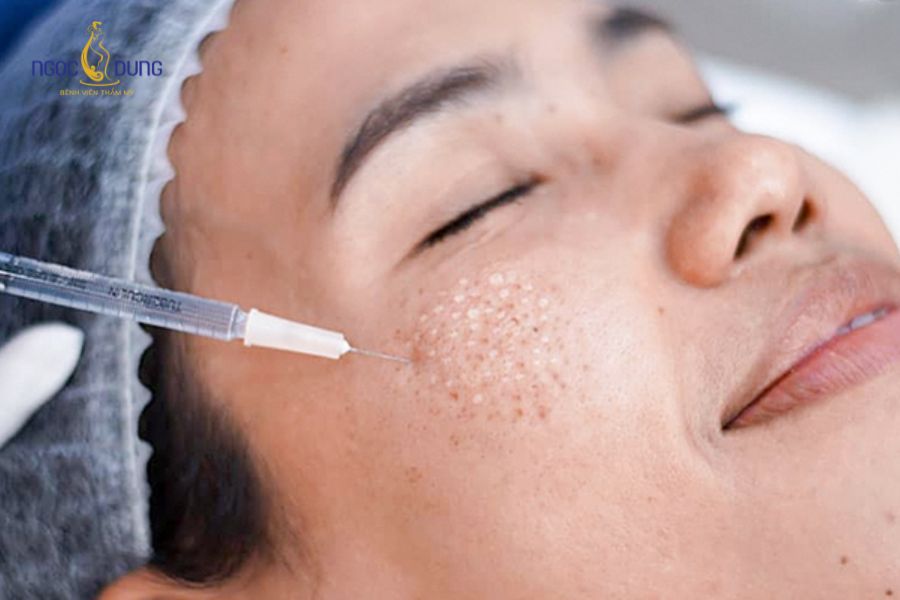 Tiêm meso trị nám có hiệu quả không? Cơ chế hoạt động và lưu ý 10 Tiêm meso trị nám là phương pháp làm đẹp phổ biến