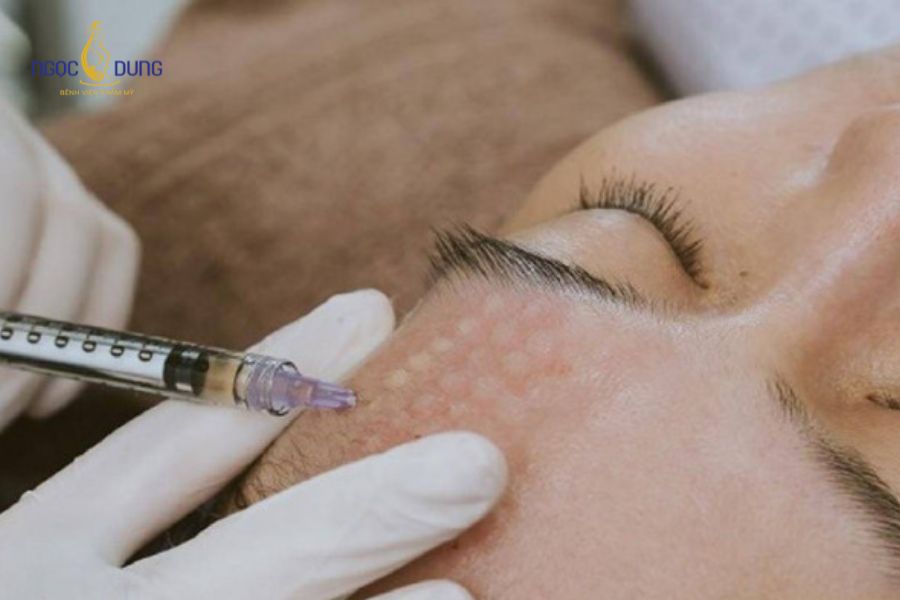 Tiêm meso trị nám có hiệu quả không? Cơ chế hoạt động và lưu ý 17 Tiêm meso trị nám ngày càng phổ biến