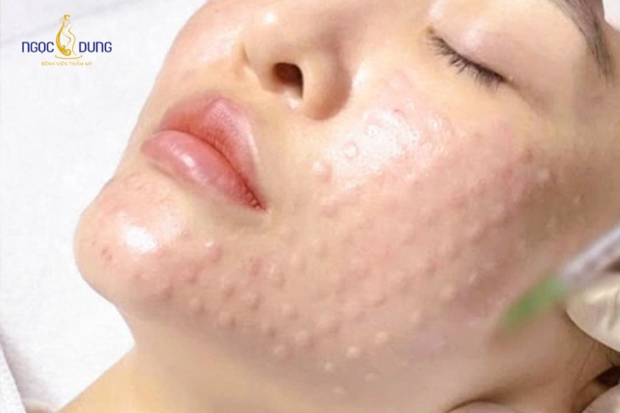 6 Tác hại của tiêm meso: Cần lưu ý trước khi thực hiện 18 Tiêm meso trị nám nhanh chóng và hiệu quả
