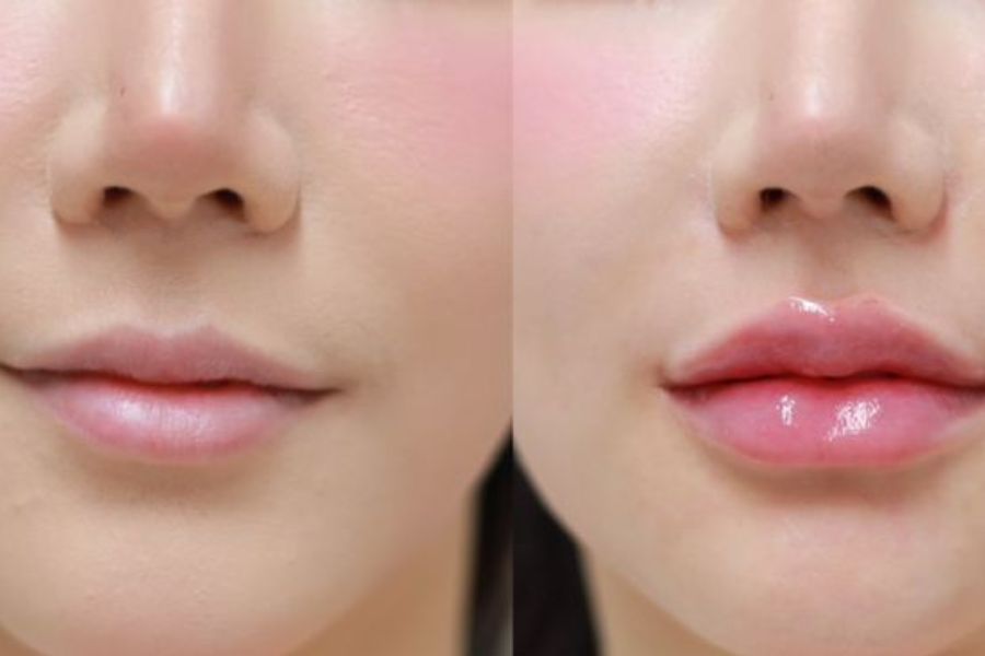 TOP 10+ dáng môi tiêm filler đẹp tự nhiên và HOT TREND hiện nay 17 Tiêm môi giúp gương mặt đẹp và hài hòa hơn