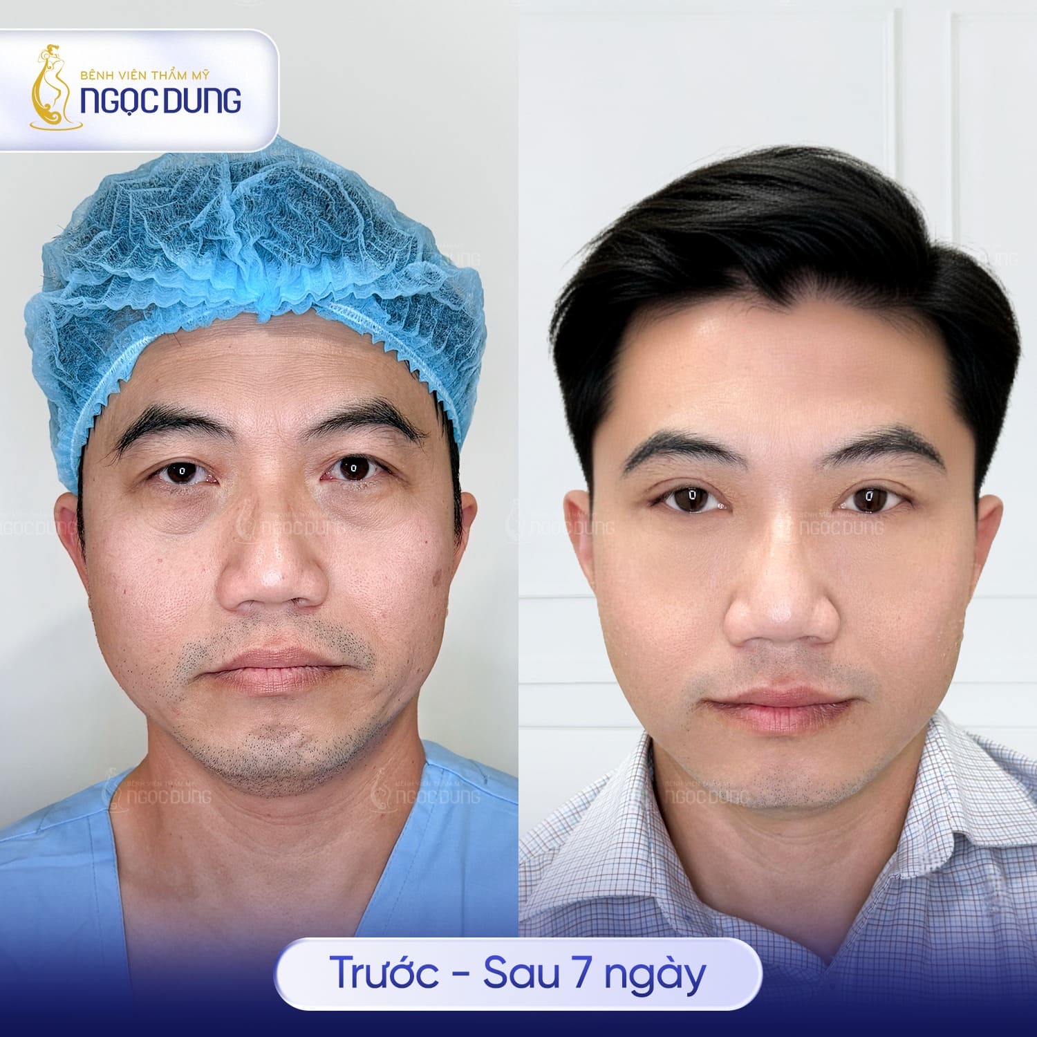Phẫu thuật cắt mỡ mí mắt trên là gì? Cách chăm sóc sau thực hiện 7 Tiểu phẫu lấy mỡ mí trên phù hợp cho cả người trẻ có bọng mỡ bẩm sinh và người trung niên bị sụp mí do lão hóa