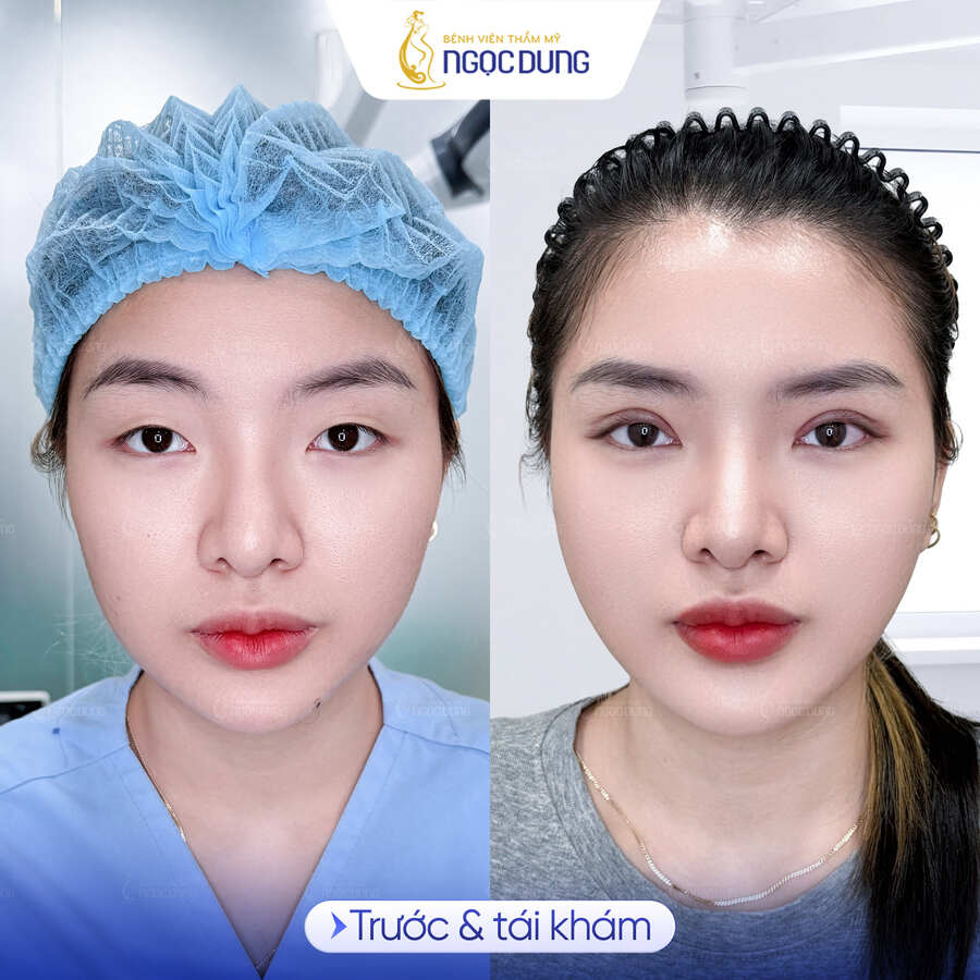 Nên cắt mí hay treo cung chân mày để đôi mắt trẻ hơn? 6 Tìm lại đôi mắt tinh anh, rạng rỡ và đẩy lùi dấu vết thời gian tại Hệ thống Bệnh viện Thẩm mỹ Ngọc Dung