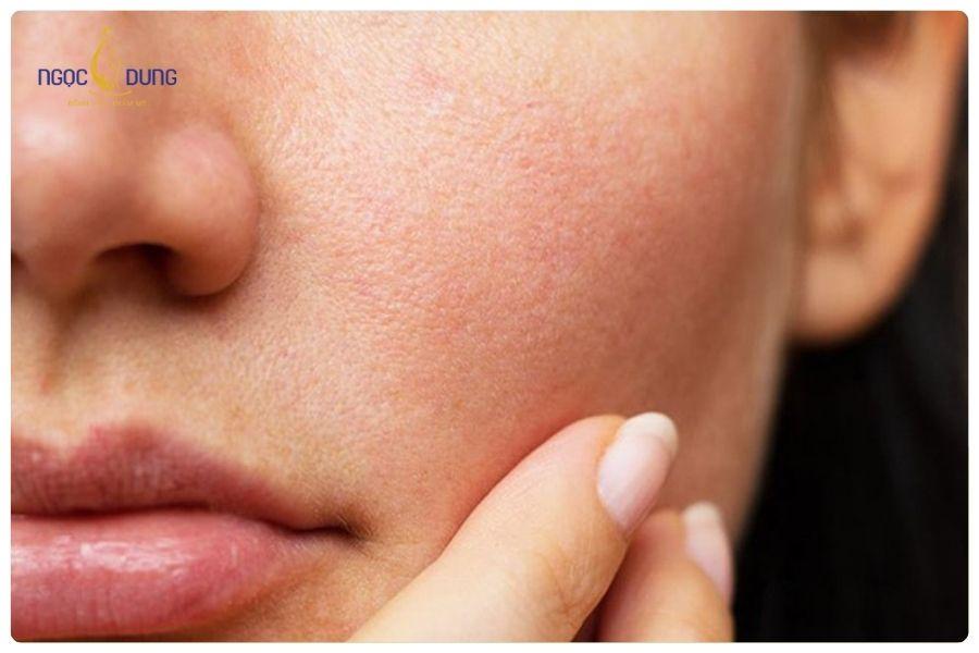 Nên tiêm Meso bao lâu 1 lần là tốt nhất? Những yếu tố ảnh hưởng 12 Tình trạng da quyết định tần suất tiêm meso nhanh hay chậm