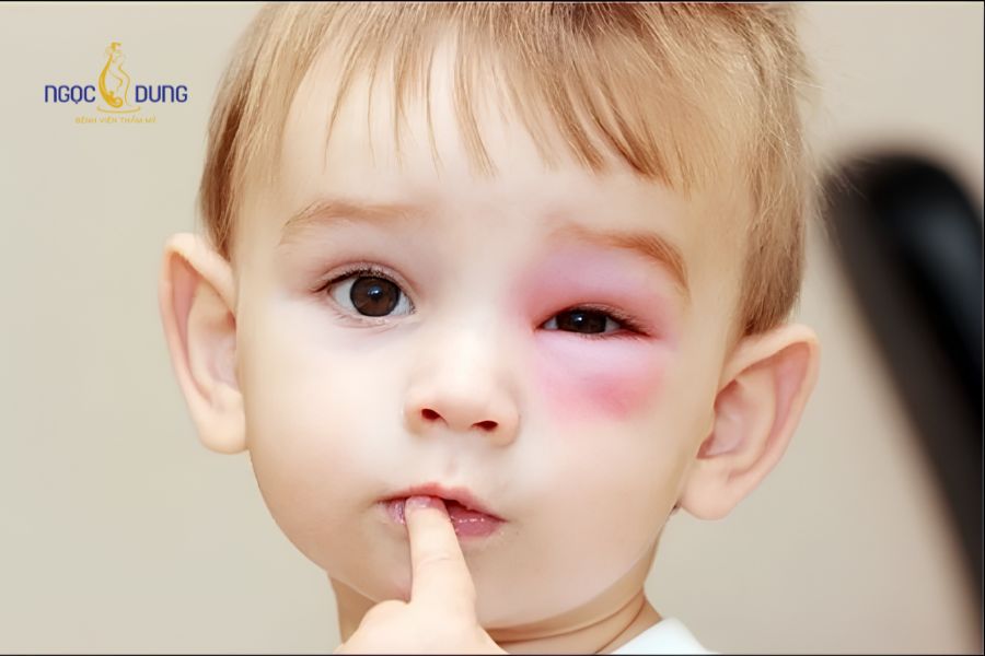 Bọng mắt bị sưng đỏ và đau là do đâu? Có nguy hiểm không? 11 Tình trạng trẻ bị sưng bọng mắt dưới cần được quan tâm và theo dõi sát sao
