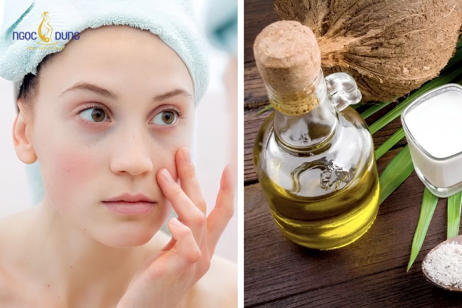 9+ cách trị bọng mắt tại nhà đơn giản và nhanh chóng 8 Trong dầu dừa có vitamin E giúp dưỡng ẩm, hỗ trợ giảm bọng mắt tốt