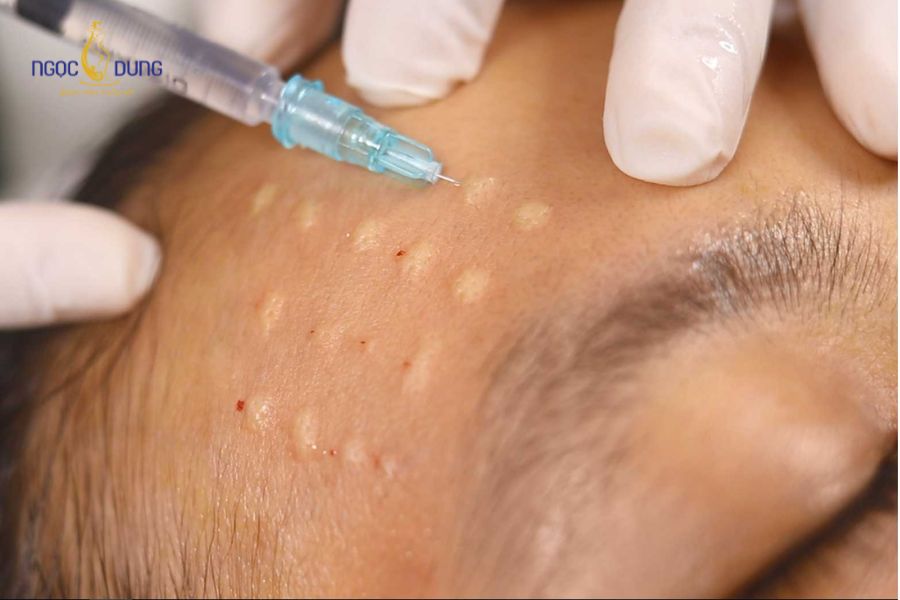Nổi u hạt sau tiêm meso và cách xử lý hiệu quả 10 U hạt thường xuất hiện muộn sau tiêm meso