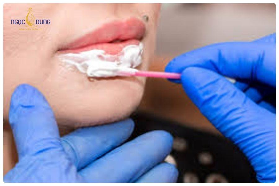 Tiêm tan filler bao lâu thì tiêm lại được? Bao lâu thì tan hết 17 Vùng tiêm sẽ được ủ tê để giảm cảm giác khó chịu trong quá trình thực hiện
