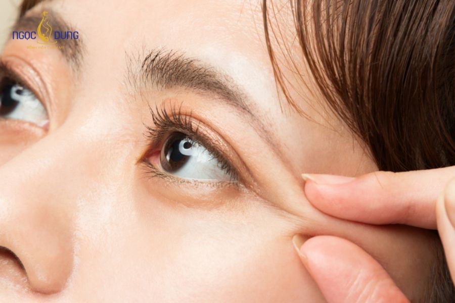Nên cắt mí hay treo cung chân mày để đôi mắt trẻ hơn? 5 Mắt sụp mí nên cắt mí hay treo cung chân mày