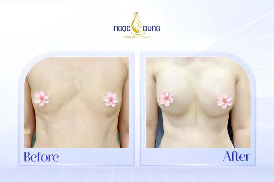 Khách hàng nâng ngực tại bệnh viện Thẩm Mỹ Ngọc Dung 3
